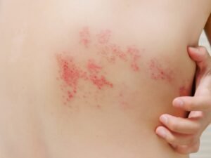 Hautkrankheit Zona aufgrund von Stress