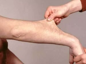 Ehlers-Danlos-Syndrom