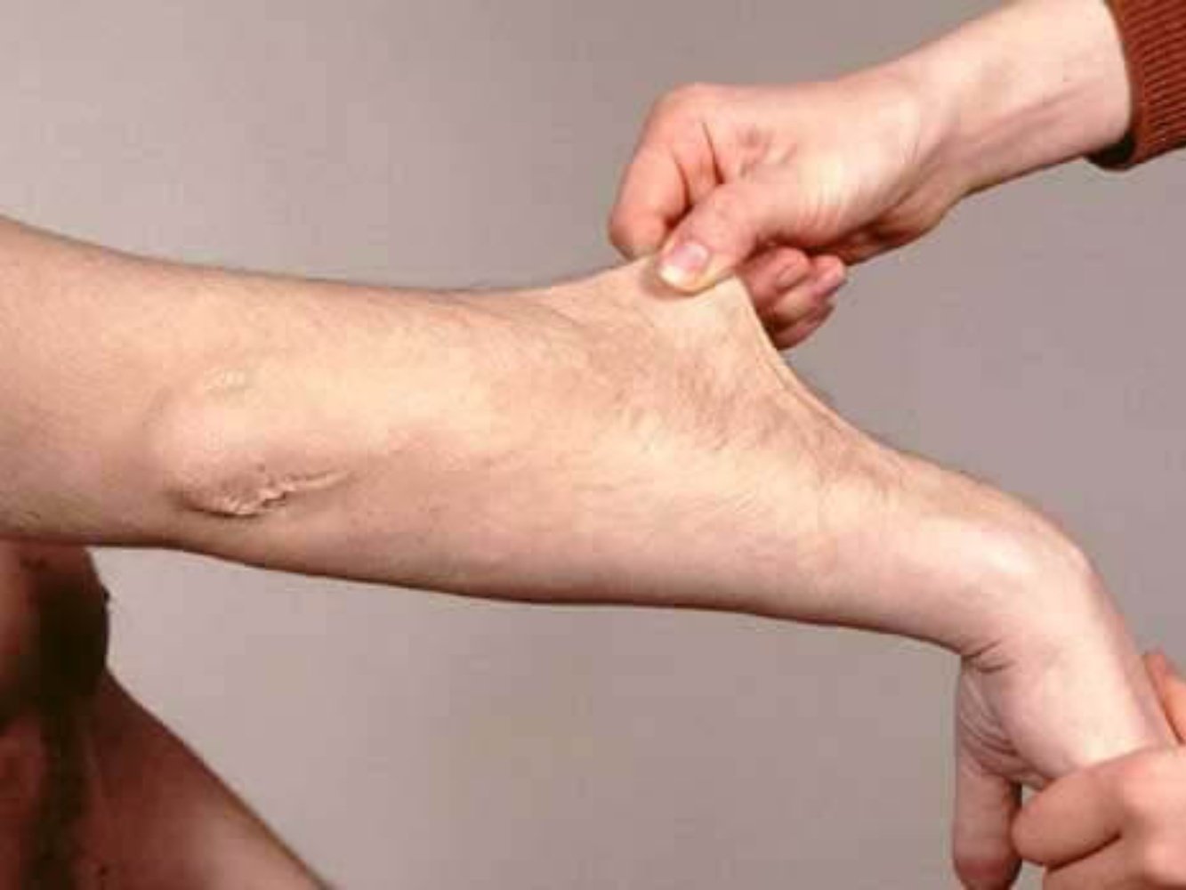 Sindrome di Ehlers-Danlos